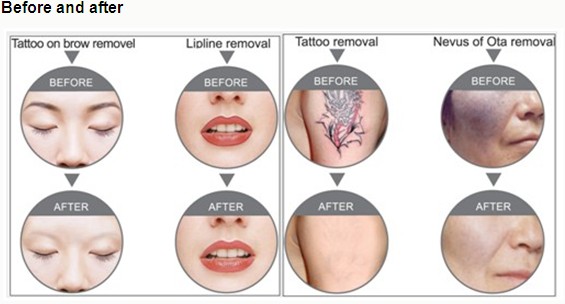 Soak Lip, Eye Line, Eyebrow Tattoo Removal Equipment, Q switched ND Yag Laser Machine 0