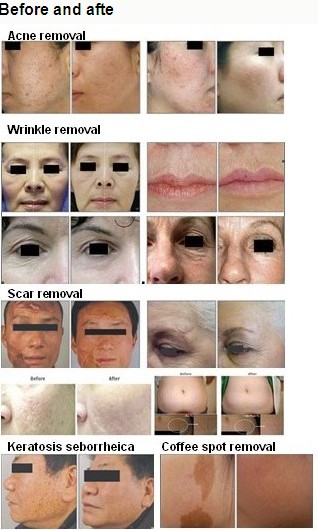 10600nm RF CO2 Fractional Laser Machine For Fine Lines And Wrinkles Removal, Acne Scares Reduction 0